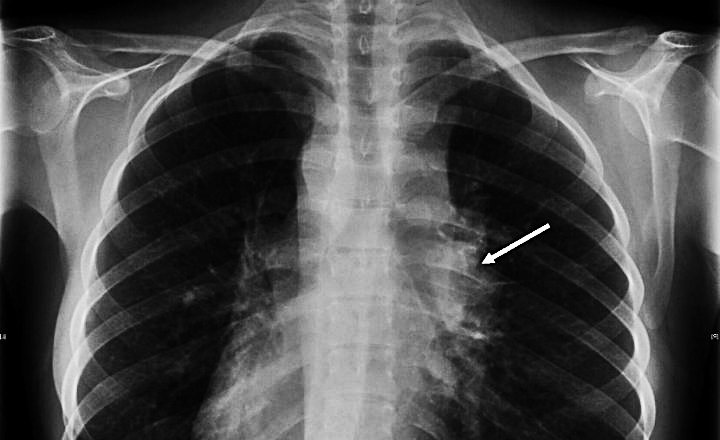 Costocondritis Costocondritis